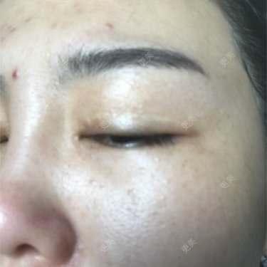 像素激光