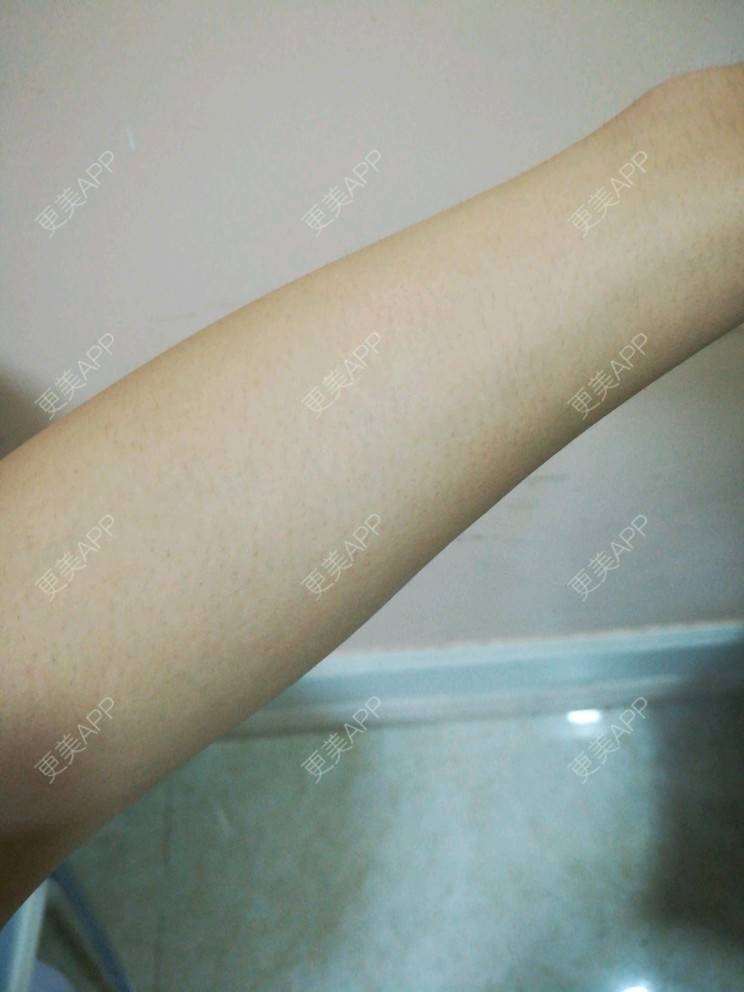 更美 - 风岚的手臂脱毛经验 | 广州 | 手臂脱毛