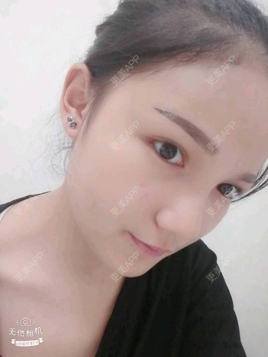 更美 - 更美用户WvyKOymayY的玻尿酸经验 | 抚州 | 玻尿酸