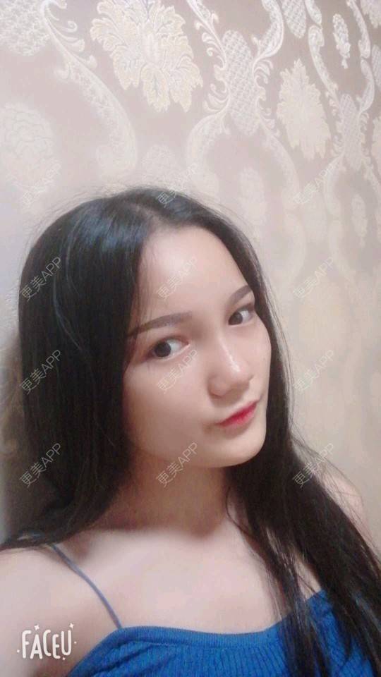更美 - 更美用户WvyKOymayY的玻尿酸经验 | 抚州 | 玻尿酸