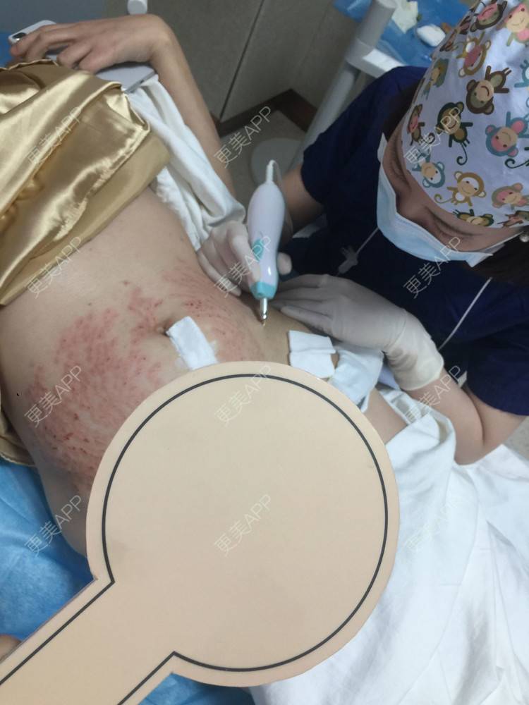 更美用户lkibp4ywtx的妊娠纹日记