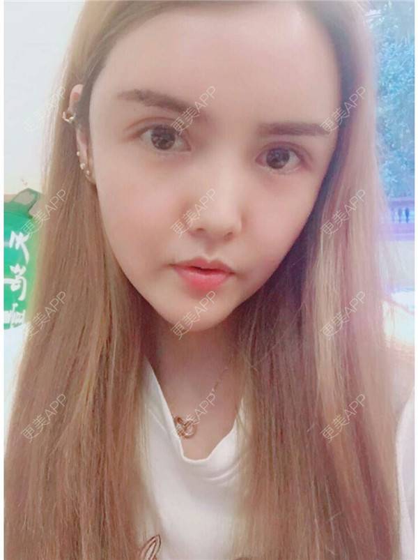 更美 - 我还好😊的玻尿酸太阳穴经验 | 深圳 | 玻尿酸太阳穴