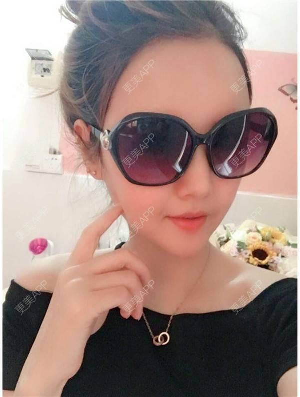 更美 - 我还好😊的玻尿酸太阳穴经验 | 深圳 | 玻尿酸太阳穴