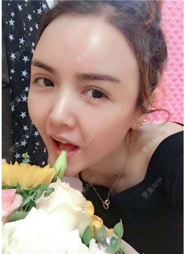 更美 - 我还好😊的玻尿酸太阳穴经验 | 深圳 | 玻尿酸太阳穴