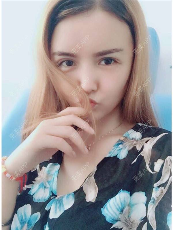 更美 - 我还好😊的玻尿酸太阳穴经验 | 深圳 | 玻尿酸太阳穴