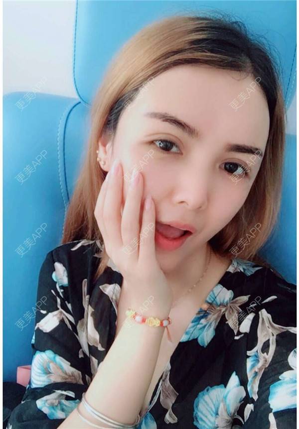 更美 - 我还好😊的玻尿酸太阳穴经验 | 深圳 | 玻尿酸太阳穴