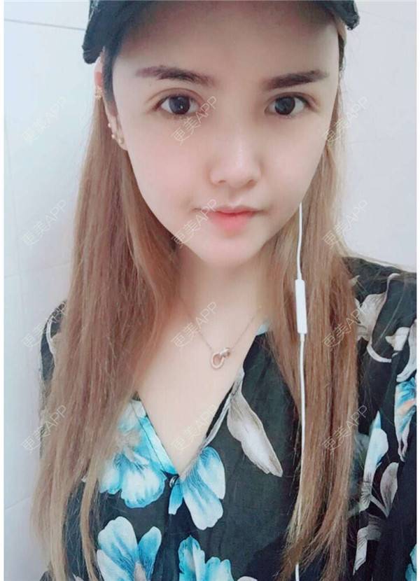 更美 - 我还好😊的玻尿酸太阳穴经验 | 深圳 | 玻尿酸太阳穴