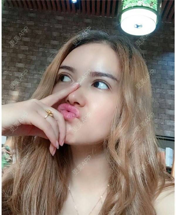 更美 - 我还好😊的玻尿酸太阳穴经验 | 深圳 | 玻尿酸太阳穴