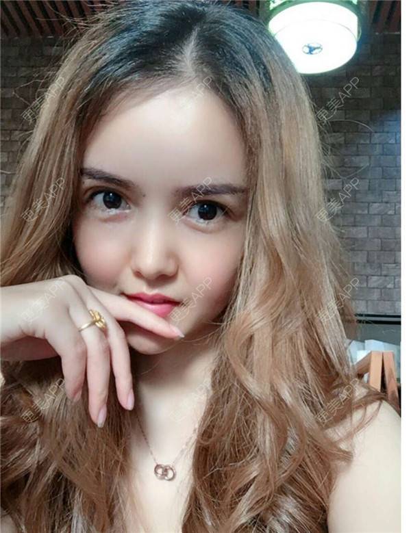 更美 - 我还好😊的玻尿酸太阳穴经验 | 深圳 | 玻尿酸太阳穴