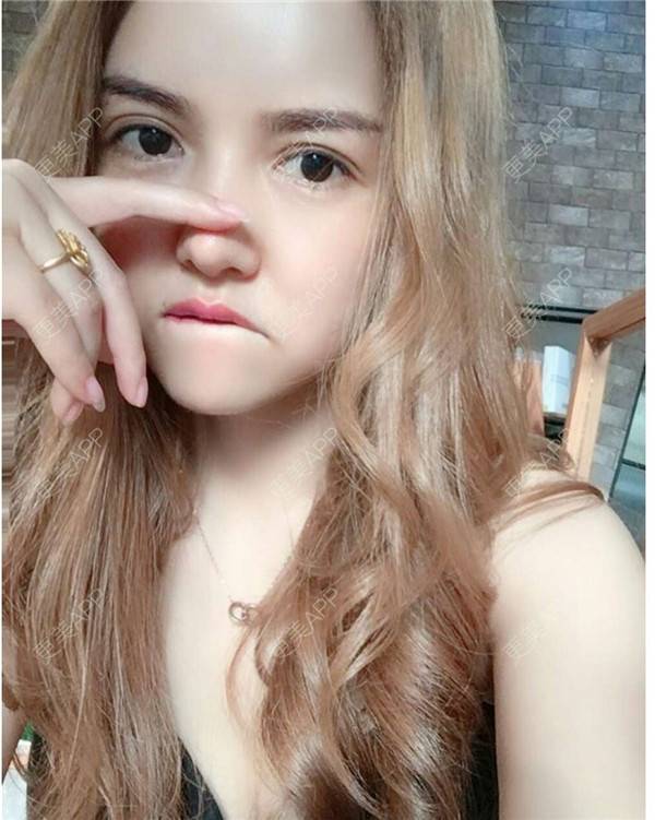 更美 - 我还好😊的玻尿酸太阳穴经验 | 深圳 | 玻尿酸太阳穴