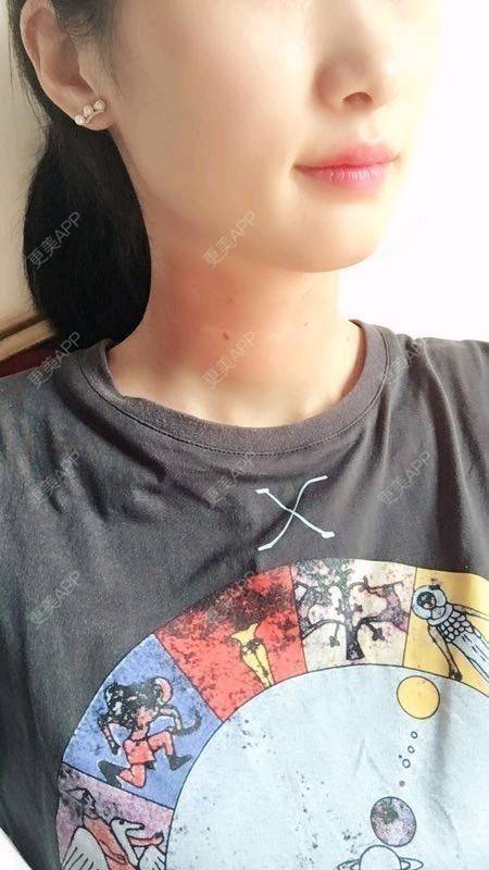 更美 - Annie嵉的自体脂肪填充颈纹经验 | 上海 | 自体脂肪填充颈纹