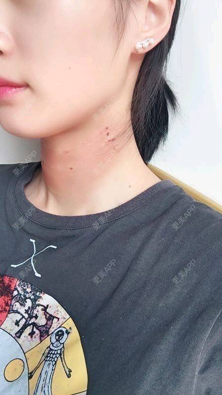 更美 - Annie嵉的自体脂肪填充颈纹经验 | 上海 | 自体脂肪填充颈纹