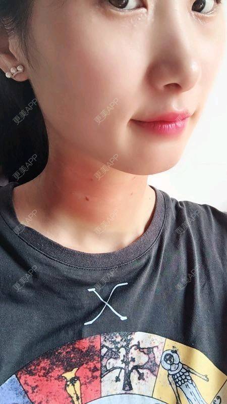 更美 - Annie嵉的自体脂肪填充颈纹经验 | 上海 | 自体脂肪填充颈纹