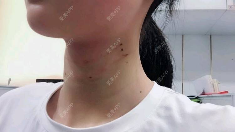 更美 - Annie嵉的自体脂肪填充颈纹经验 | 上海 | 自体脂肪填充颈纹