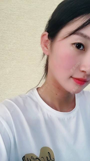 更美 - Annie嵉的自体脂肪填充颈纹经验 | 上海 | 自体脂肪填充颈纹