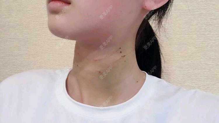 更美 - Annie嵉的自体脂肪填充颈纹经验 | 上海 | 自体脂肪填充颈纹