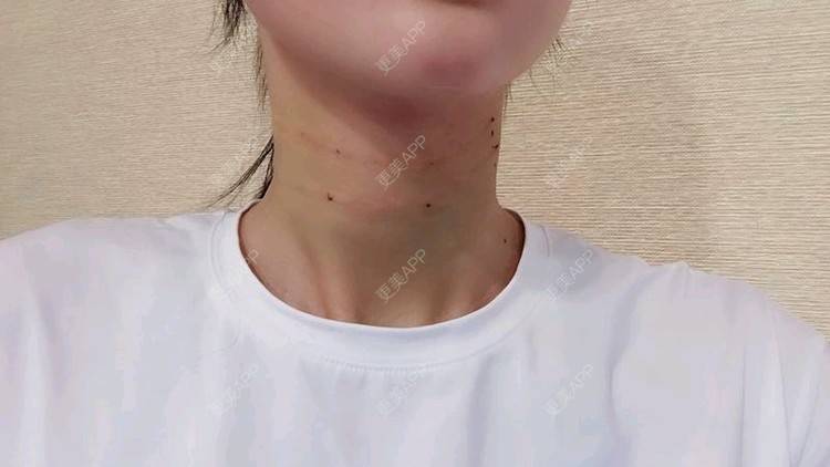 更美 - Annie嵉的自体脂肪填充颈纹经验 | 上海 | 自体脂肪填充颈纹