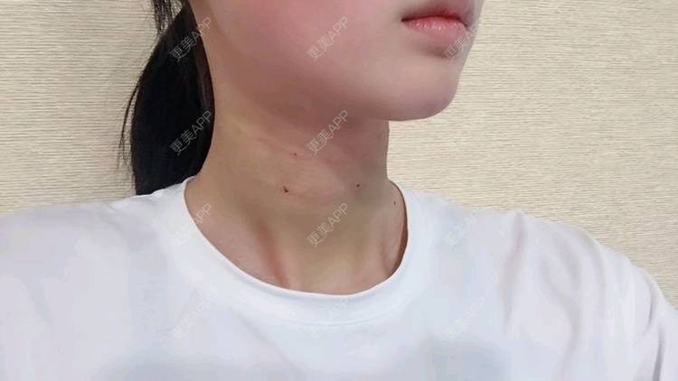 更美 - Annie嵉的自体脂肪填充颈纹经验 | 上海 | 自体脂肪填充颈纹