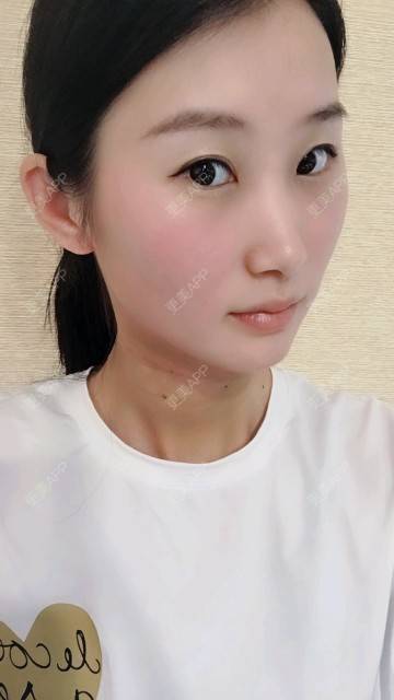 更美 - Annie嵉的自体脂肪填充颈纹经验 | 上海 | 自体脂肪填充颈纹