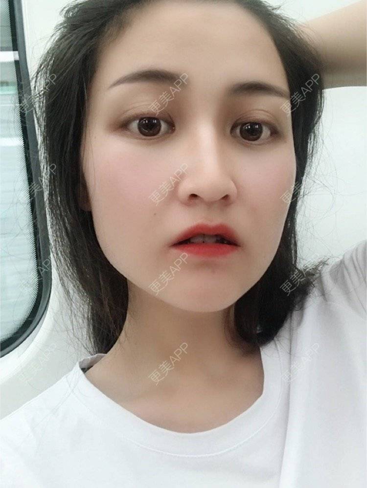 之前只期望改善塌鼻子的缺点,对鼻形设计还很抽象,也在各种翘鼻,直鼻