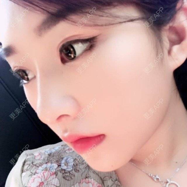 颜小姐要脸的隆鼻日记