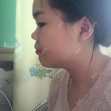 鼻部整形