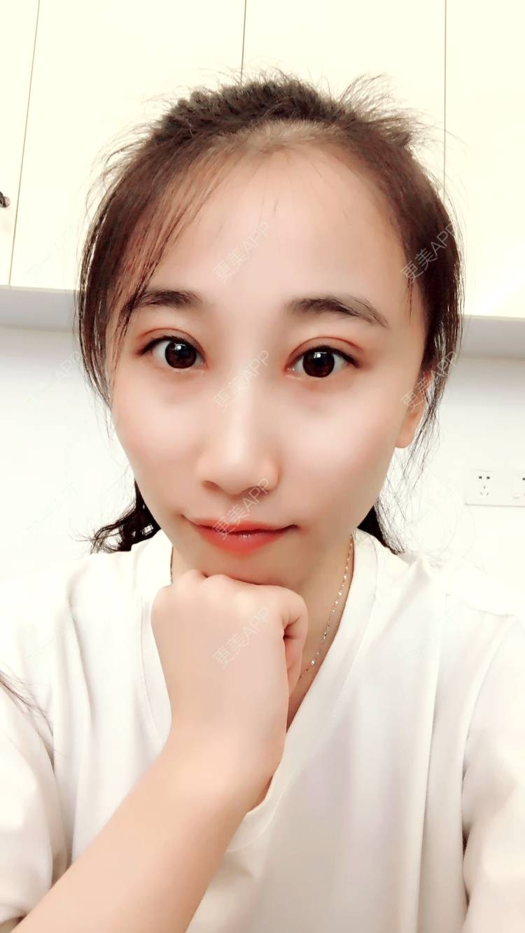 穆慧斌医生的全切双眼皮日记