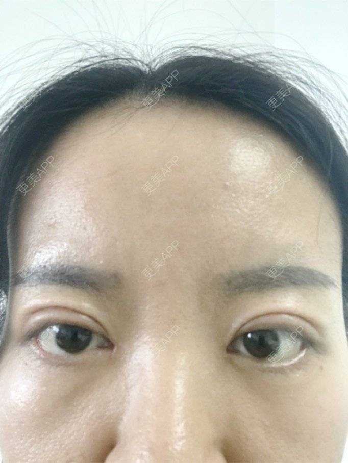 更美用户eo8xibef0z的双眼皮日记