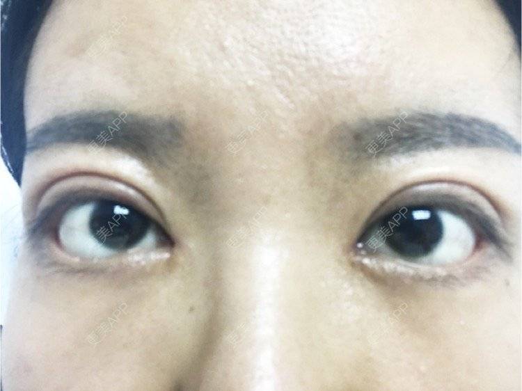 更美用户eo8xibef0z的双眼皮日记