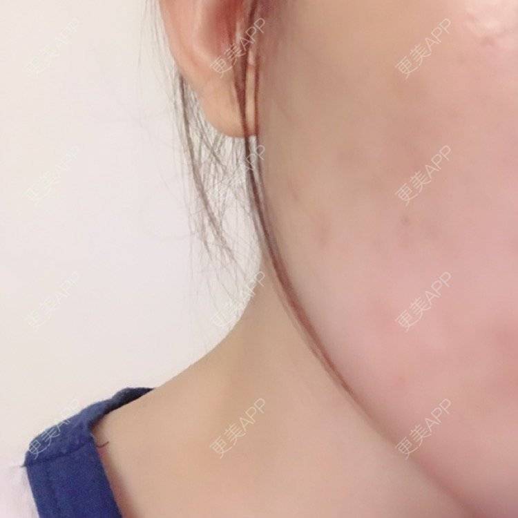 更美 - 岸边等风也等你的除皱瘦脸经验 | 成都 | 注射美肤 | 北京 | 淡化皱纹 | 水光项目 | 佛山 | 双眼皮 | 福州 | 激光脱腋毛 | 广州 | 南昌 | 嘉兴 | 深圳 | 吸脂 | 玻尿酸 | 黄金微针 | 激光脱毛 | 埋线提升 | 除皱瘦脸 | 吸脂瘦脸 | 注射美白