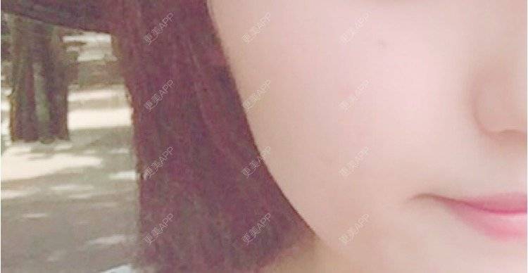 更美 - 岸边等风也等你的除皱瘦脸经验 | 成都 | 注射美肤 | 北京 | 淡化皱纹 | 水光项目 | 佛山 | 双眼皮 | 福州 | 激光脱腋毛 | 广州 | 南昌 | 嘉兴 | 深圳 | 吸脂 | 玻尿酸 | 黄金微针 | 激光脱毛 | 埋线提升 | 除皱瘦脸 | 吸脂瘦脸 | 注射美白