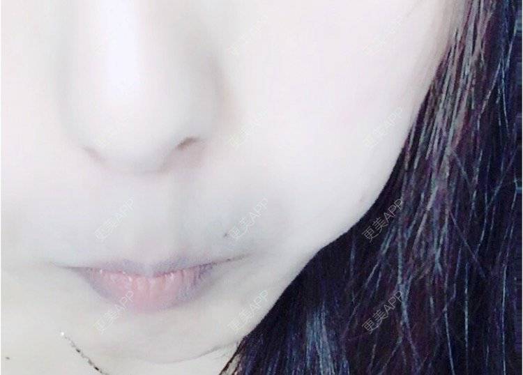 更美 - 岸边等风也等你的除皱瘦脸经验 | 成都 | 注射美肤 | 北京 | 淡化皱纹 | 水光项目 | 佛山 | 双眼皮 | 福州 | 激光脱腋毛 | 广州 | 南昌 | 嘉兴 | 深圳 | 吸脂 | 玻尿酸 | 黄金微针 | 激光脱毛 | 埋线提升 | 除皱瘦脸 | 吸脂瘦脸 | 注射美白
