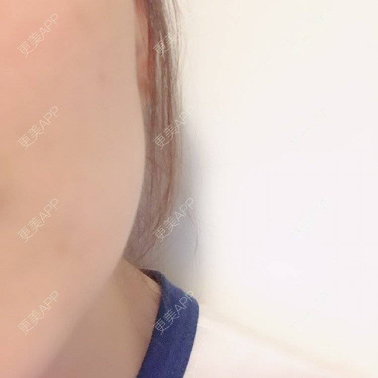 更美 - 岸边等风也等你的除皱瘦脸经验 | 成都 | 注射美肤 | 北京 | 淡化皱纹 | 水光项目 | 佛山 | 双眼皮 | 福州 | 激光脱腋毛 | 广州 | 南昌 | 嘉兴 | 深圳 | 吸脂 | 玻尿酸 | 黄金微针 | 激光脱毛 | 埋线提升 | 除皱瘦脸 | 吸脂瘦脸 | 注射美白