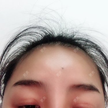 全切双眼皮已经两个月了肉条感还很明显正常吗