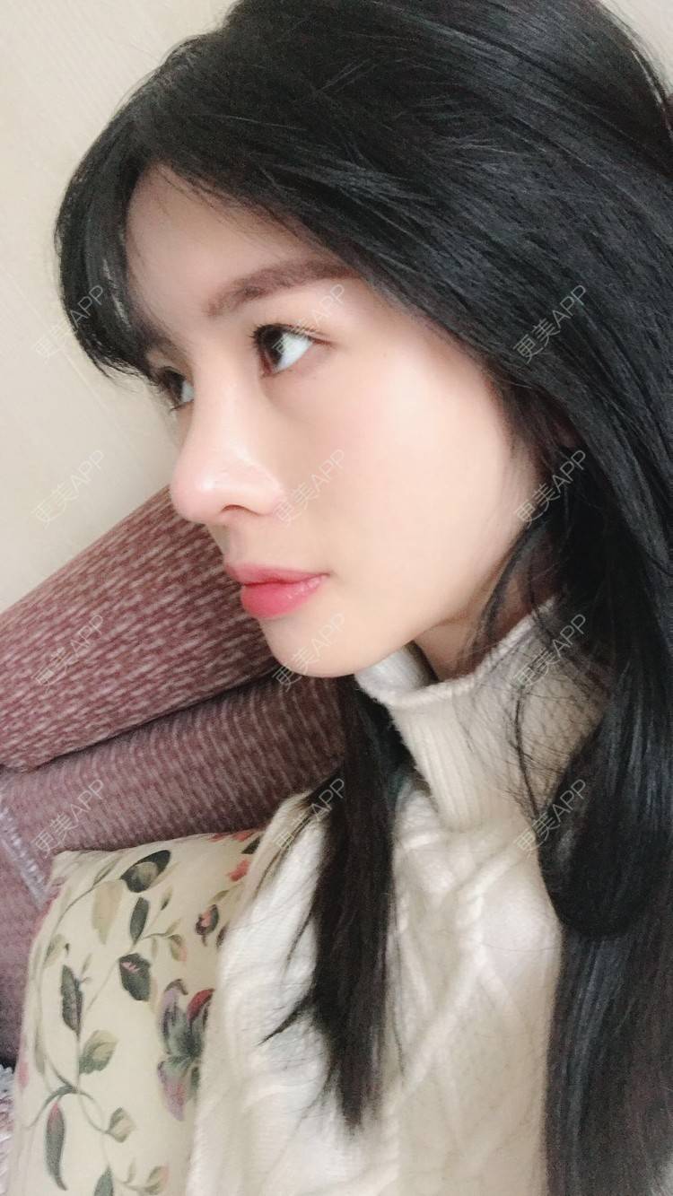 随性自在的隆鼻日记