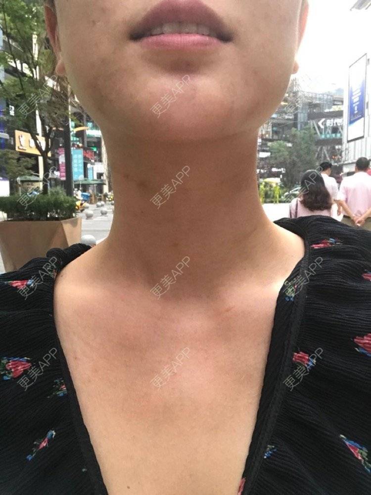 更美 - 看不开小姐的玻尿酸颈纹经验 | 玻尿酸颈纹 | 重庆
