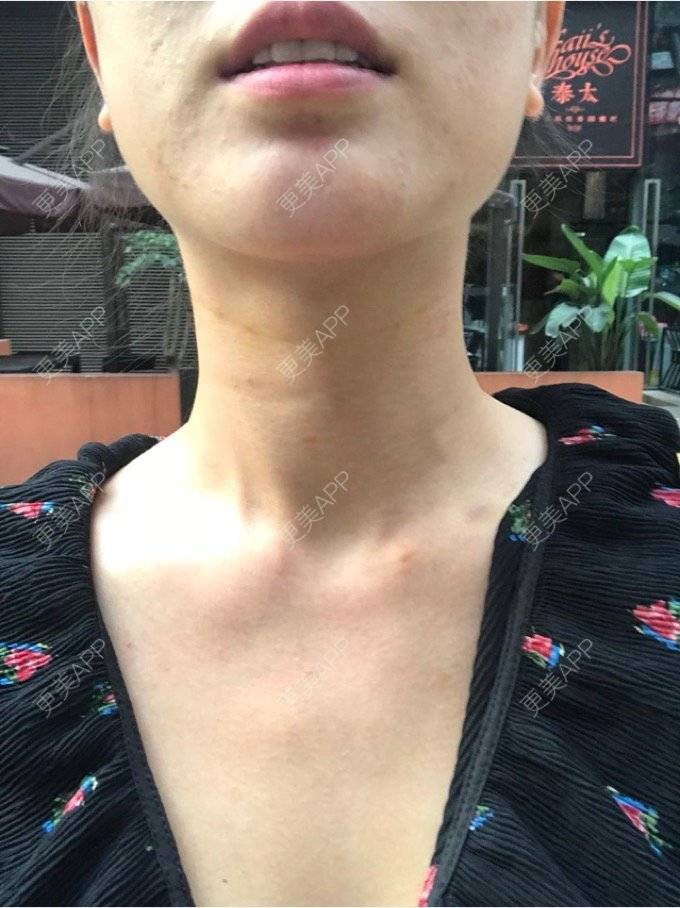 更美 - 看不开小姐的玻尿酸颈纹经验 | 玻尿酸颈纹 | 重庆