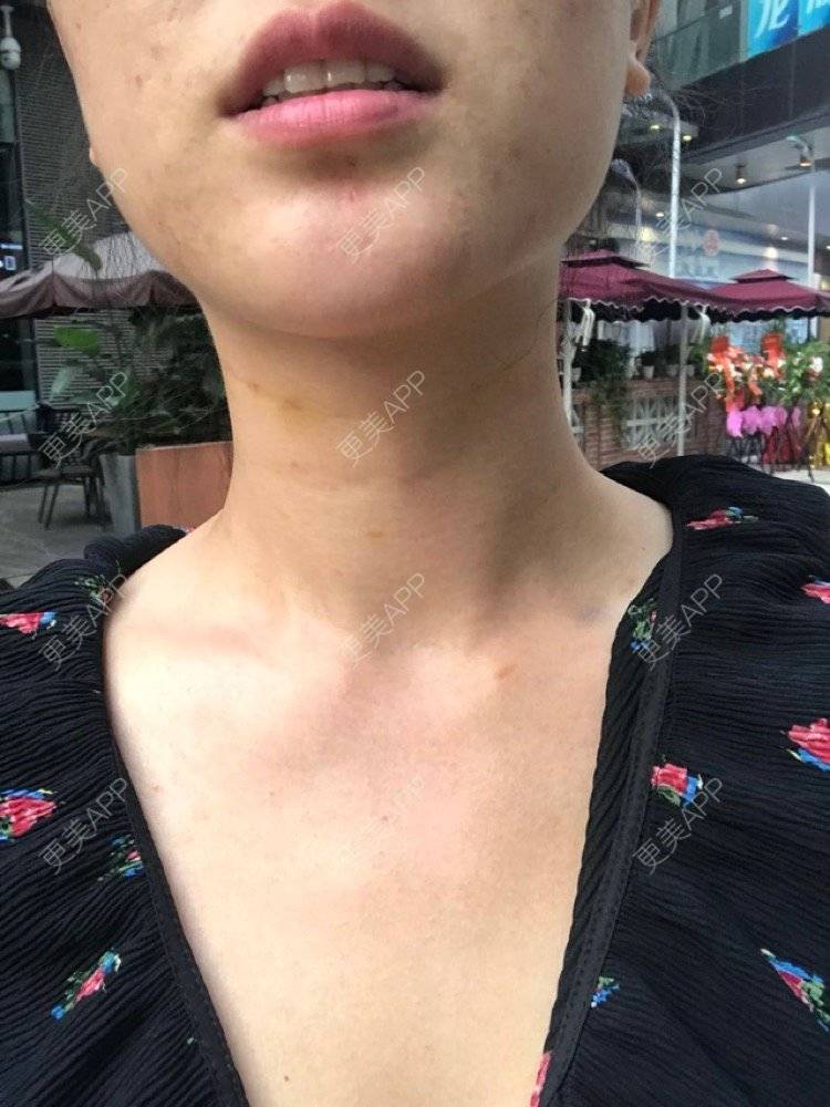更美 - 看不开小姐的玻尿酸颈纹经验 | 玻尿酸颈纹 | 重庆
