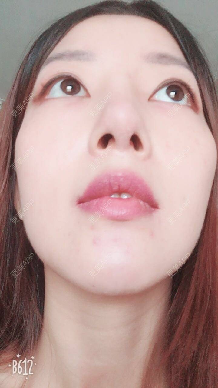 皒没有过爱舜纲桶的硅胶隆鼻日记