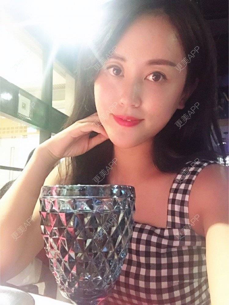 更美 - 看不开小姐的玻尿酸颈纹经验 | 玻尿酸颈纹 | 重庆