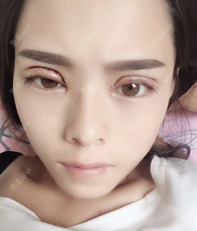 全切双眼皮效果图_惊六全切双眼皮效果图_术后61天__更美