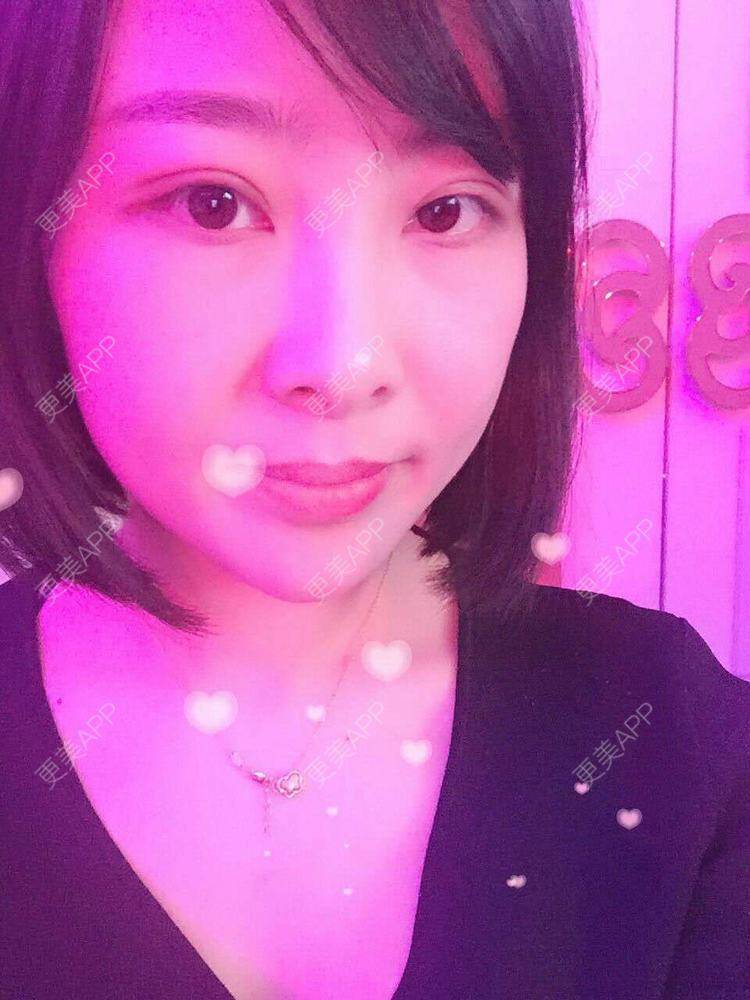 更美 - 于晓云 医生的全切双眼皮经验 | 沈阳 | 全切双眼皮