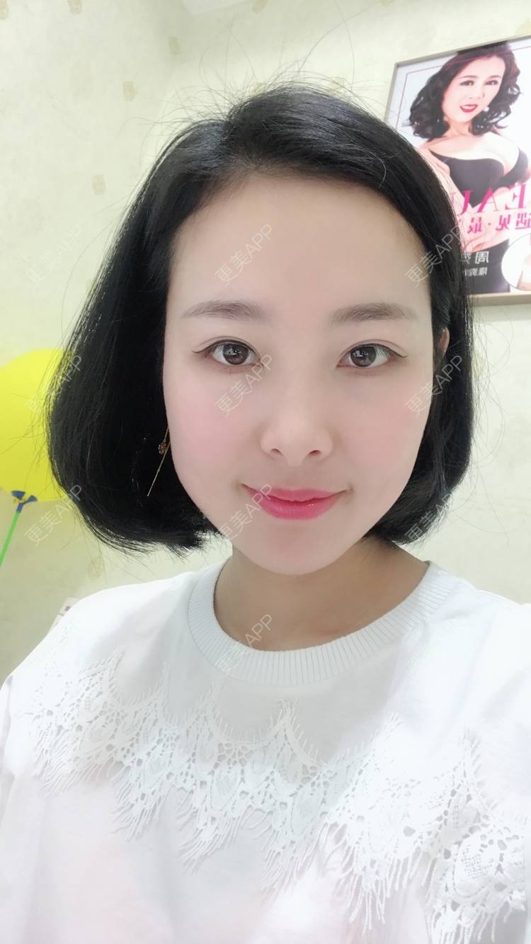 更美 - 于晓云 医生的全切双眼皮经验 | 沈阳 | 全切双眼皮