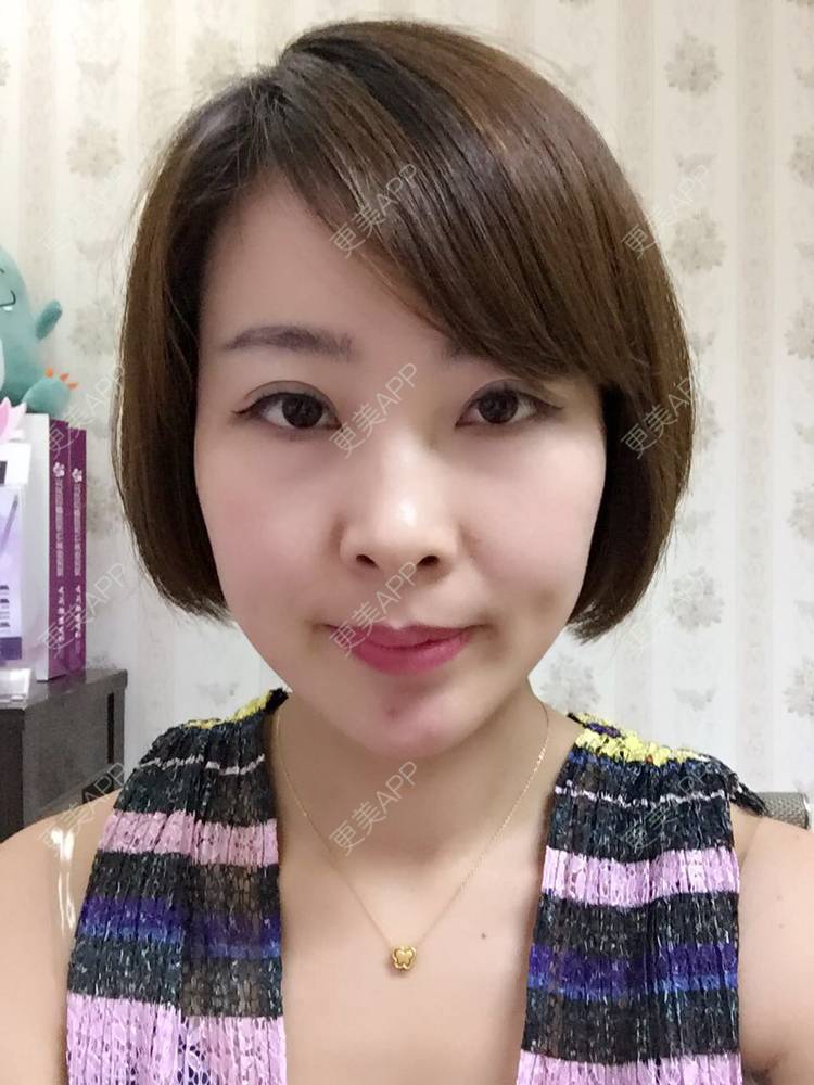 更美 - 于晓云 医生的全切双眼皮经验 | 沈阳 | 全切双眼皮