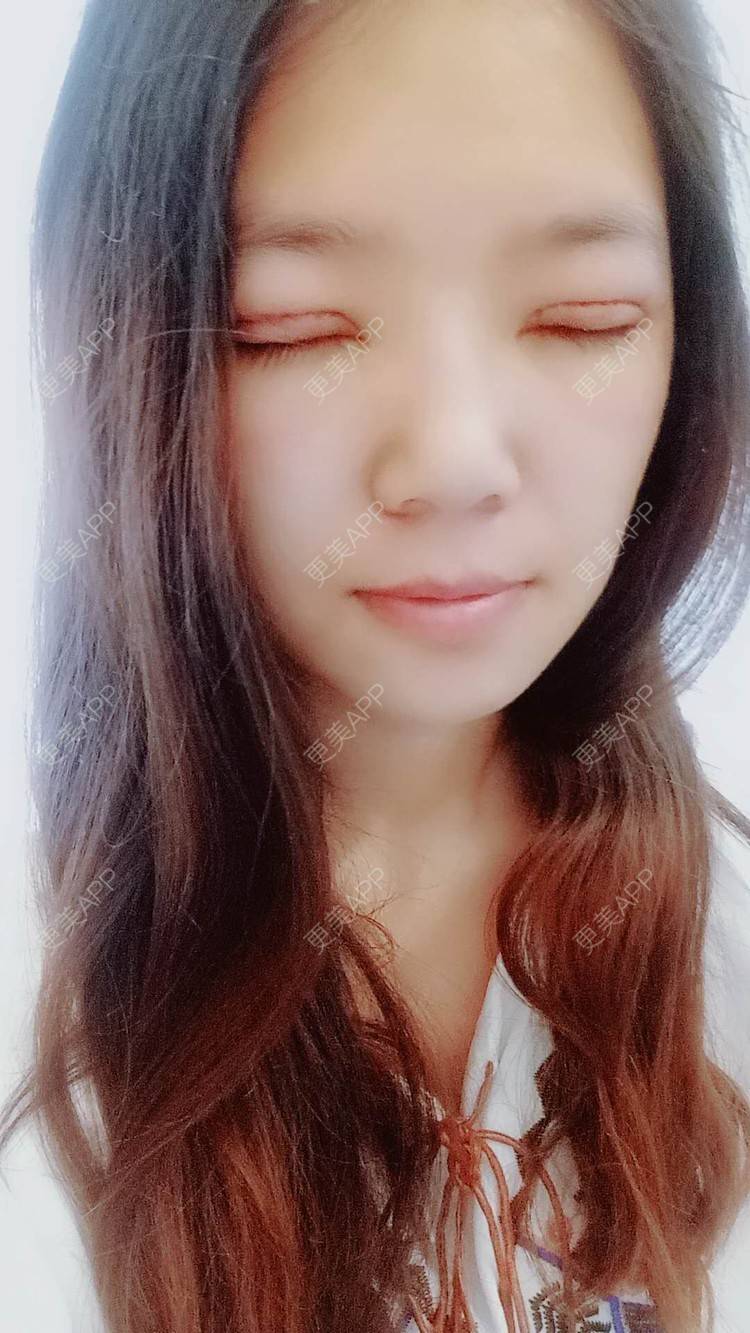 全切双眼皮效果图_更美用户ghmkylxgpf全切双眼皮效果图_术后76天__更