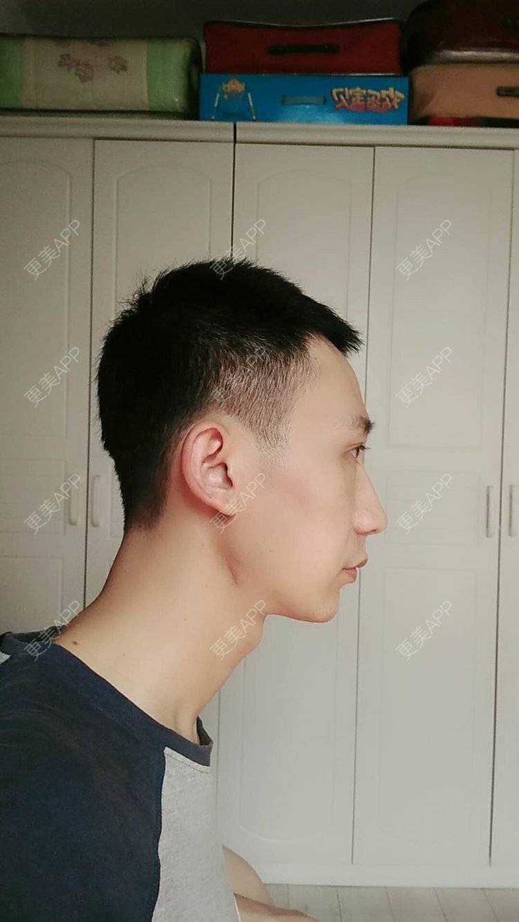 下颌外翻且不对称的下颌角日记