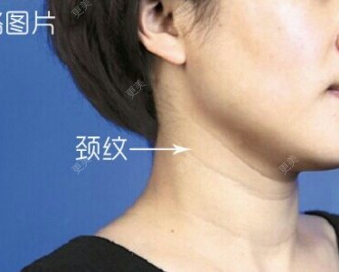 自体脂肪全面部填充