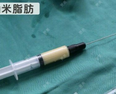 自体脂肪全面部填充