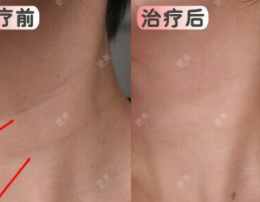 自体脂肪全面部填充