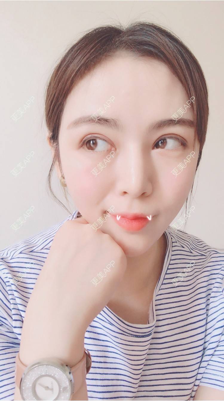 全切双眼皮效果图_蔓越莓气泡水全切双眼皮效果图_术后157天__更美